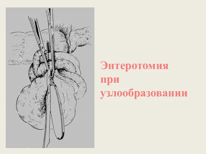 Энтеротомия при узлообразовании