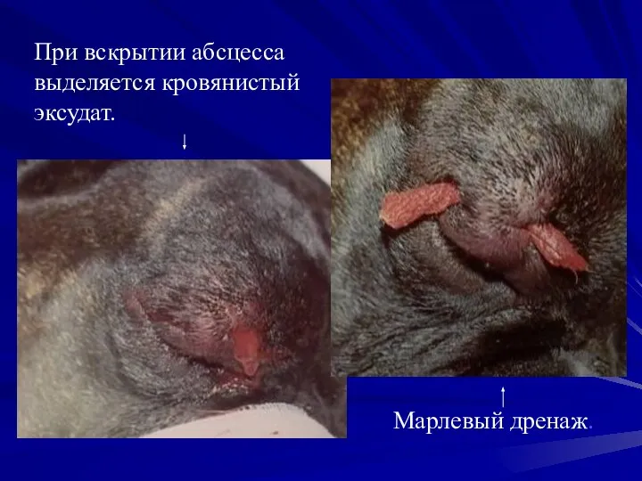 При вскрытии абсцесса выделяется кровянистый эксудат. Марлевый дренаж.