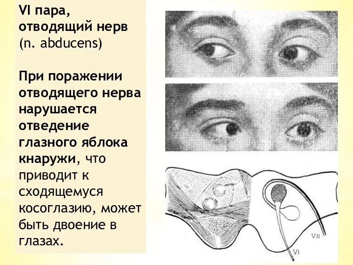 VI пара, отводящий нерв (n. abducens) При поражении отводящего нерва нарушается