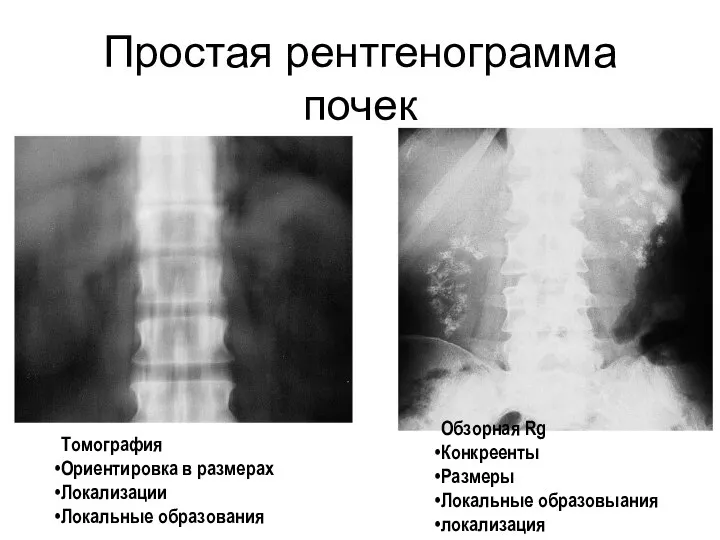 Простая рентгенограмма почек Томография Ориентировка в размерах Локализации Локальные образования Обзорная