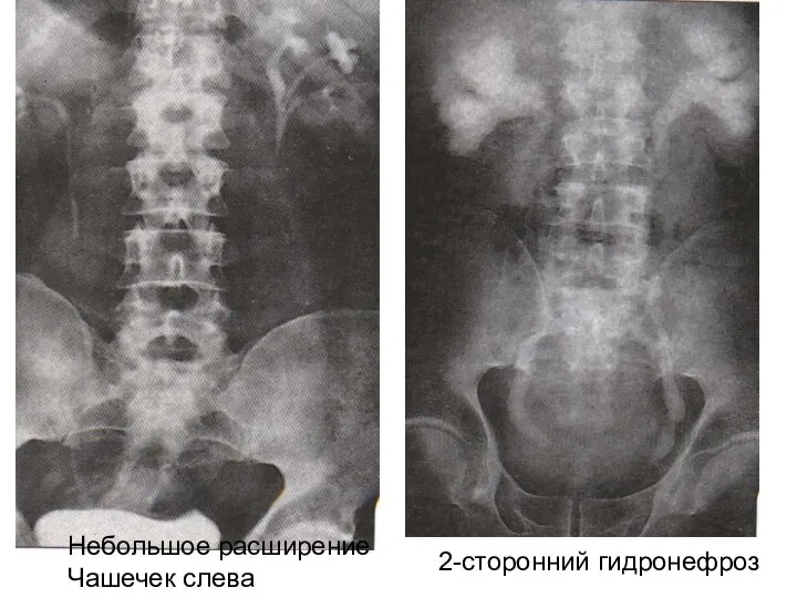 Небольшое расширение Чашечек слева Небольшое расширение Чашечек слева 2-сторонний гидронефроз Обструкция на уровне устьев мочеточников