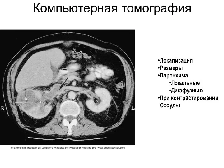 Компьютерная томография Локализация Размеры Паренхима Локальные Диффузные При контрастировании Сосуды