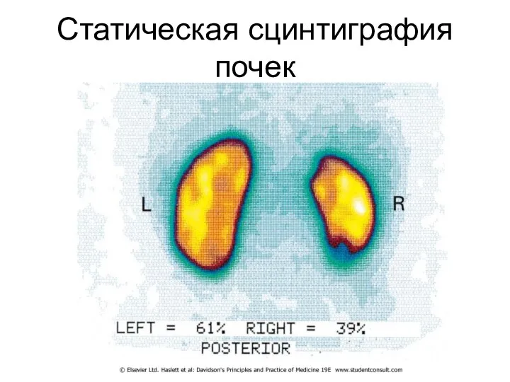 Статическая сцинтиграфия почек