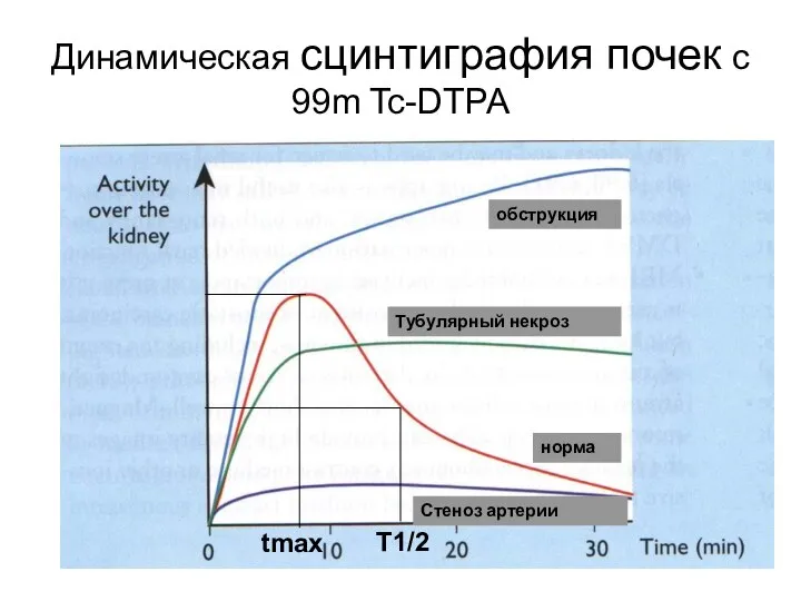 Динамическая сцинтиграфия почек с 99m Tc-DTPA норма Тубулярный некроз обструкция Стеноз артерии tmax T1/2