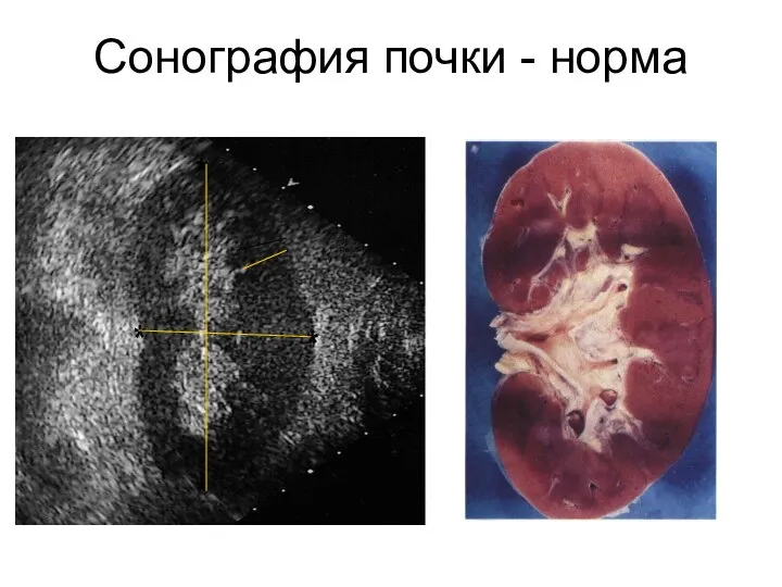 Сонография почки - норма * * * *