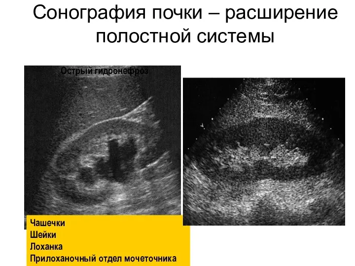 Cонография почки – расширение полостной системы Чашечки Шейки Лоханка Прилоханочный отдел мочеточника Острый гидронефроз