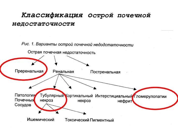 Классификация острой почечной недостаточности