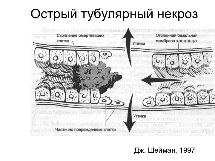 Острый тубулярный некроз Дж. Шейман, 1997