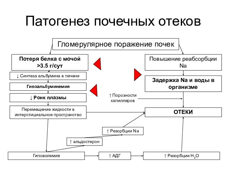 Патогенез почечных отеков Гломерулярное поражение почек Потеря белка с мочой >3.5