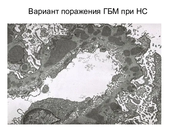 Вариант поражения ГБМ при НС