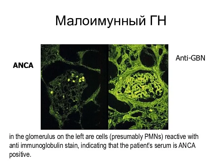 Малоимунный ГН in the glomerulus on the left are cells (presumably