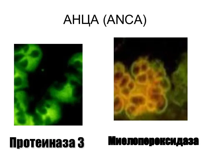 АНЦА (ANCA) Протеиназа 3 Миелопероксидаза
