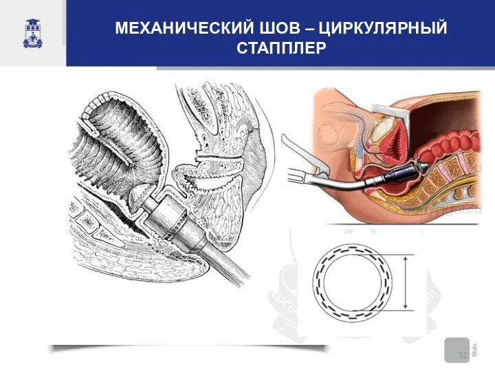 МЕХАНИЧЕСКИЙ ШОВ – ЦИРКУЛЯРНЫЙ СТАППЛЕР