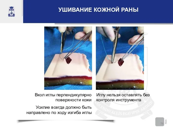 УШИВАНИЕ КОЖНОЙ РАНЫ Вкол иглы перпендикулярно поверхности кожи Усилие всегда должно