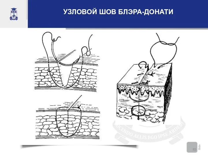 УЗЛОВОЙ ШОВ БЛЭРА-ДОНАТИ