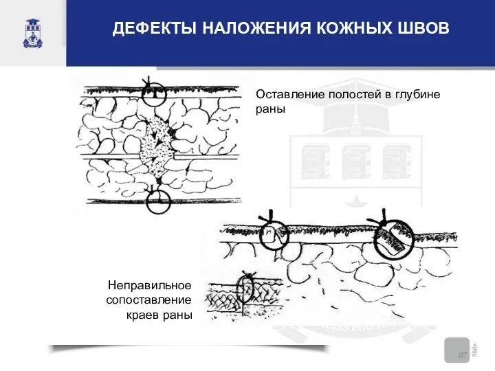 ДЕФЕКТЫ НАЛОЖЕНИЯ КОЖНЫХ ШВОВ Неправильное сопоставление краев раны Оставление полостей в глубине раны