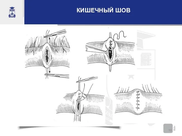 КИШЕЧНЫЙ ШОВ