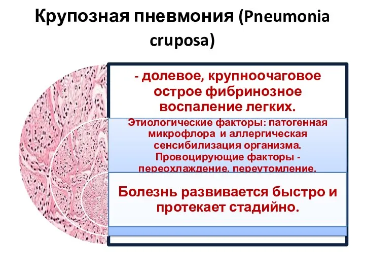 Крупозная пневмония (Pneumonia cruposa)