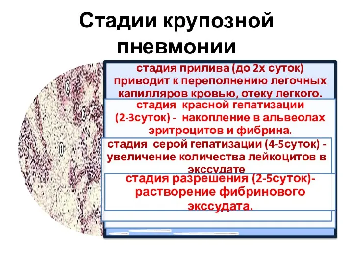 Стадии крупозной пневмонии