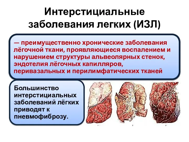 Интерстициальные заболевания легких (ИЗЛ)