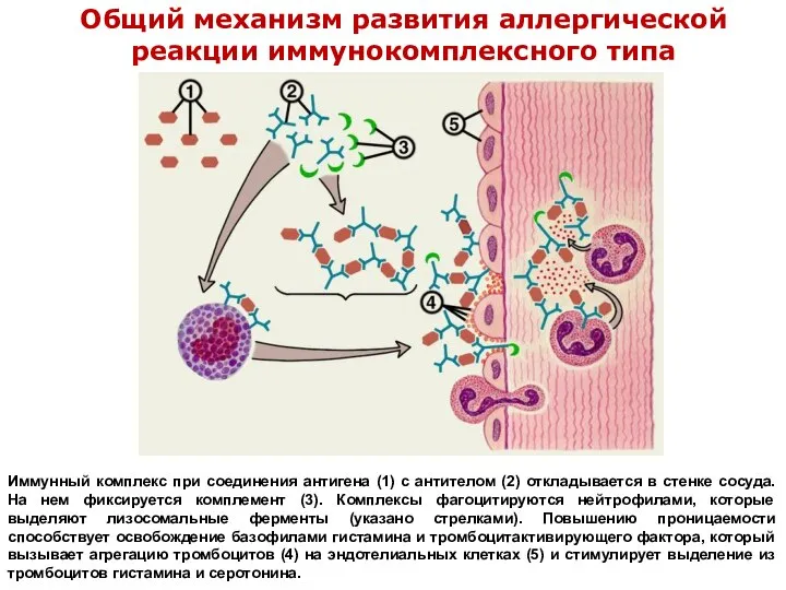 Общий механизм развития аллергической реакции иммунокомплексного типа Иммунный комплекс при соединения