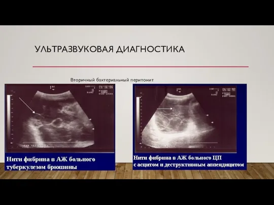 Вторичный бактериальный перитонит УЛЬТРАЗВУКОВАЯ ДИАГНОСТИКА