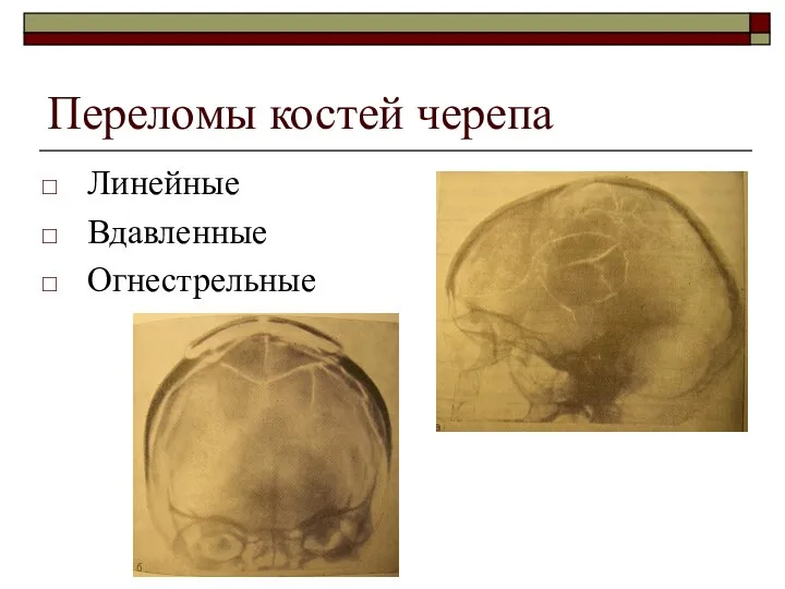 Переломы костей черепа Линейные Вдавленные Огнестрельные