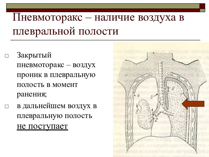 Пневмоторакс – наличие воздуха в плевральной полости Закрытый пневмоторакс – воздух