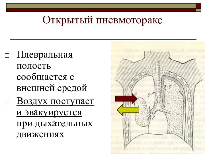 Открытый пневмоторакс Плевральная полость сообщается с внешней средой Воздух поступает и эвакуируется при дыхательных движениях