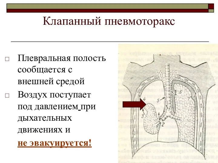 Клапанный пневмоторакс Плевральная полость сообщается с внешней средой Воздух поступает под