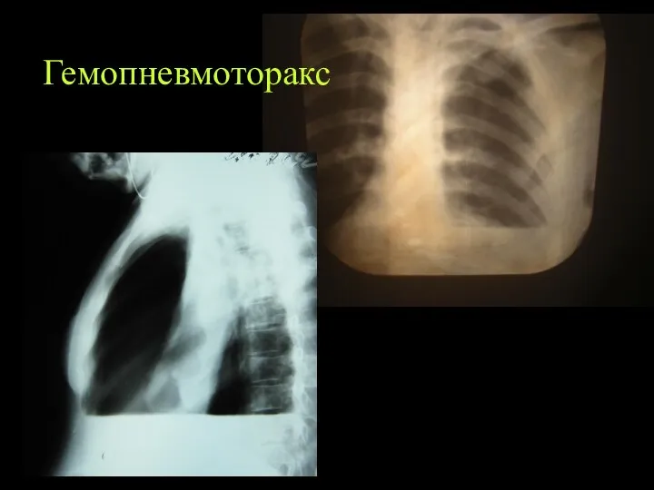 Гемопневмоторакс