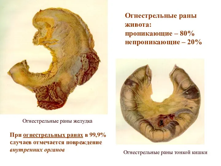 Огнестрельные раны желудка Огнестрельные раны живота: проникающие – 80% непроникающие –