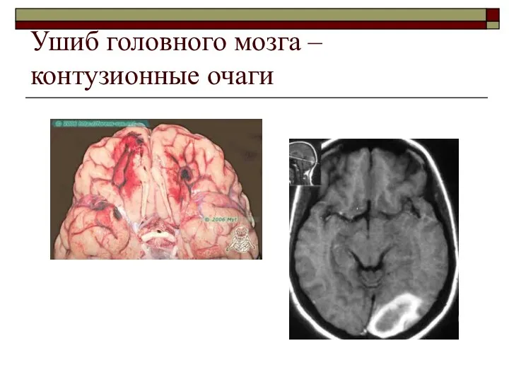 Ушиб головного мозга – контузионные очаги