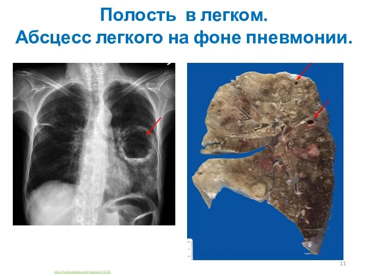 Полость в легком. Абсцесс легкого на фоне пневмонии. http://radiopaedia.org/images/272139