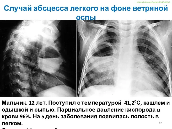 Случай абсцесса легкого на фоне ветряной оспы http://adc.bmj.com/content/87/2/110.full Мальчик. 12 лет.