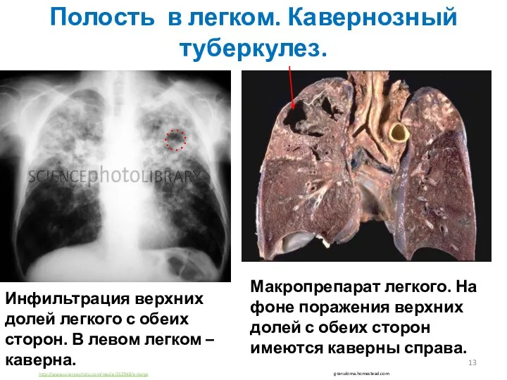 Полость в легком. Кавернозный туберкулез. http://www.sciencephoto.com/media/262948/enlarge Инфильтрация верхних долей легкого с