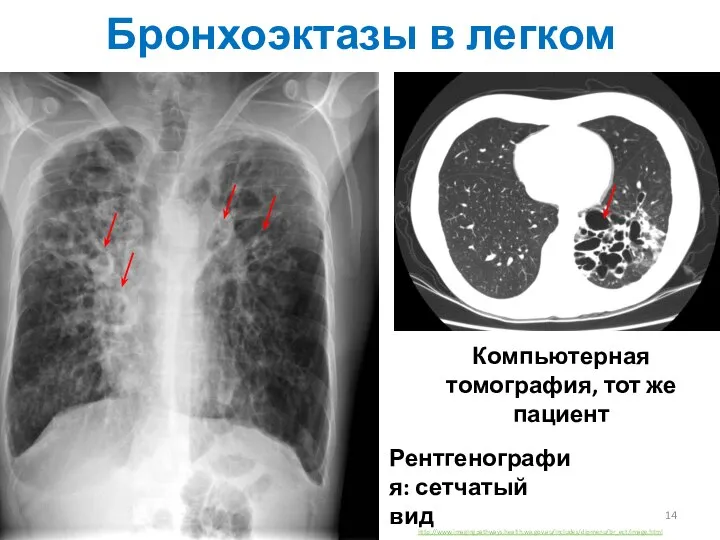 Бронхоэктазы в легком Компьютерная томография, тот же пациент Рентгенография: сетчатый вид http://www.imagingpathways.health.wa.gov.au/includes/dipmenu/br_ect/image.html