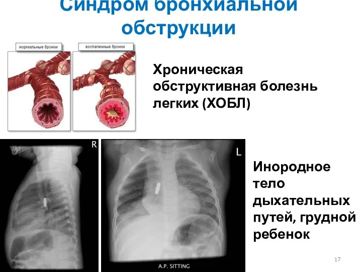 Синдром бронхиальной обструкции Хроническая обструктивная болезнь легких (ХОБЛ) Инородное тело дыхательных путей, грудной ребенок