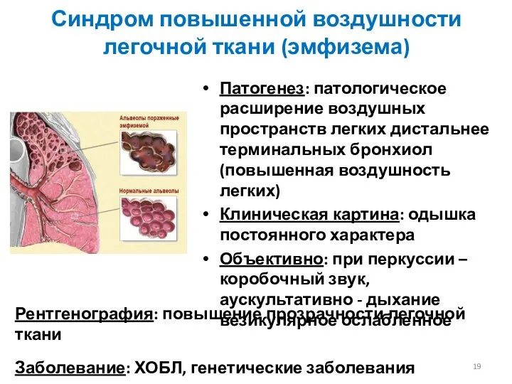 Синдром повышенной воздушности легочной ткани (эмфизема) Патогенез: патологическое расширение воздушных пространств