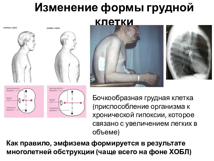 Изменение формы грудной клетки Бочкообразная грудная клетка (приспособление организма к хронической