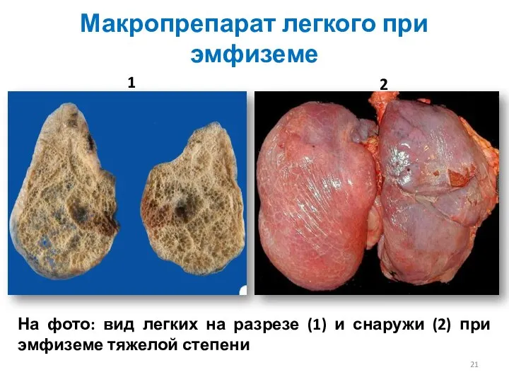 Макропрепарат легкого при эмфиземе На фото: вид легких на разрезе (1)