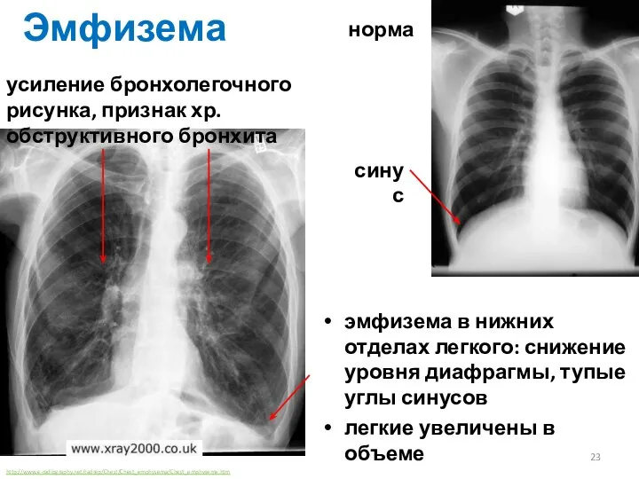 Эмфизема эмфизема в нижних отделах легкого: снижение уровня диафрагмы, тупые углы