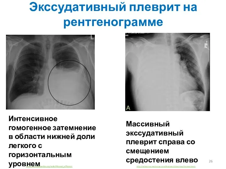 Экссудативный плеврит на рентгенограмме http://en.wikipedia.org/wiki/Pleural_effusion Интенсивное гомогенное затемнение в области нижней