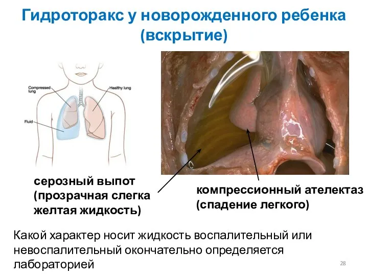 Гидроторакс у новорожденного ребенка (вскрытие) серозный выпот (прозрачная слегка желтая жидкость)