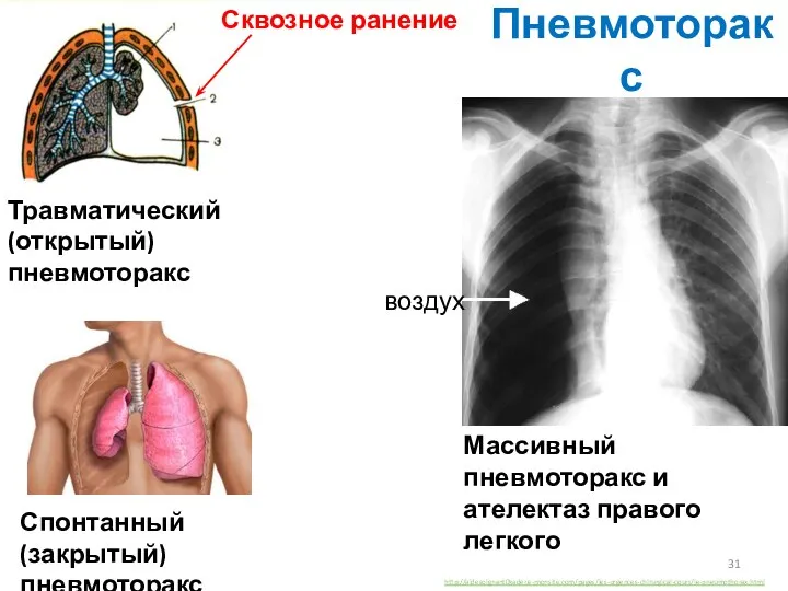 Пневмоторакс Травматический (открытый) пневмоторакс Спонтанный (закрытый) пневмоторакс Сквозное ранение http://aidesoignant0kader.e-monsite.com/pages/les-urgences-chirurgical-cours/le-pneumothorax.html Массивный