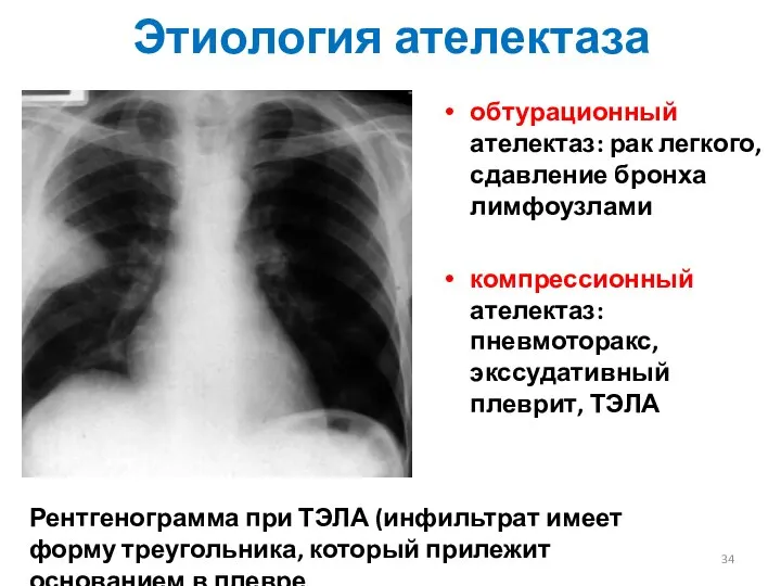 Этиология ателектаза обтурационный ателектаз: рак легкого, сдавление бронха лимфоузлами компрессионный ателектаз: