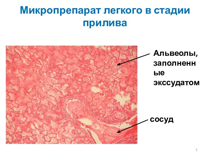 Микропрепарат легкого в стадии прилива сосуд Альвеолы, заполненные экссудатом