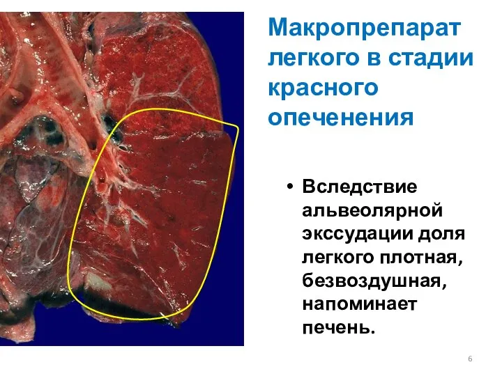 Макропрепарат легкого в стадии красного опеченения Вследствие альвеолярной экссудации доля легкого плотная, безвоздушная, напоминает печень.