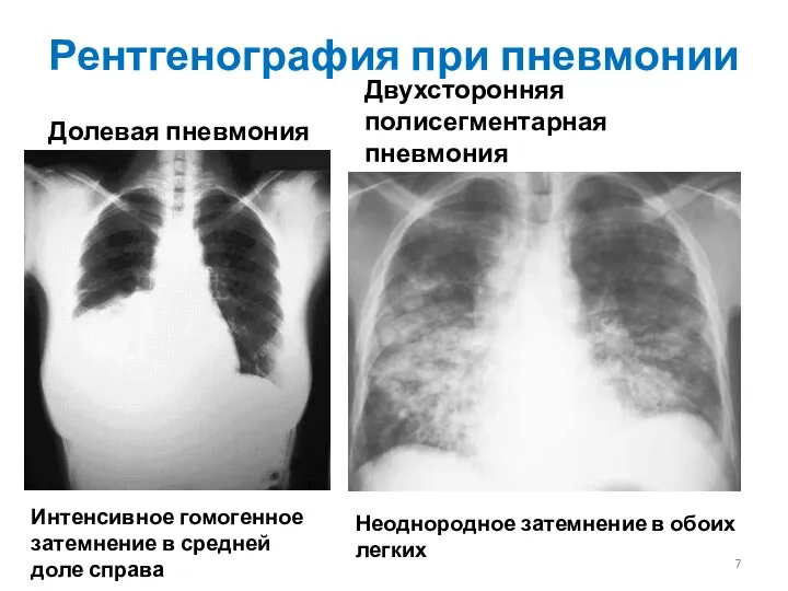 Рентгенография при пневмонии Долевая пневмония Двухсторонняя полисегментарная пневмония Интенсивное гомогенное затемнение