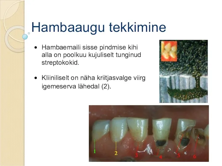 Hambaaugu tekkimine Hambaemaili sisse pindmise kihi alla on poolkuu kujuliselt tunginud